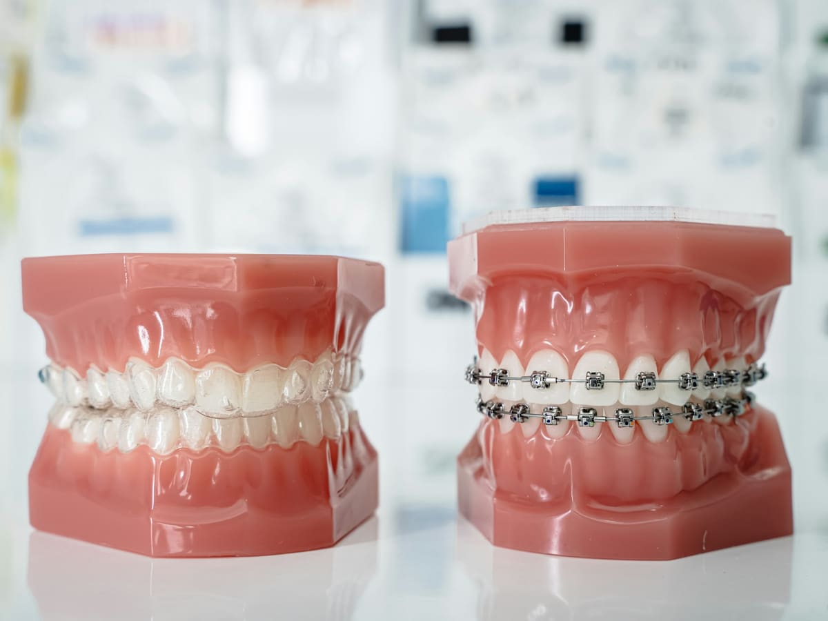Modèle dentaire avec bagues orthodontiques