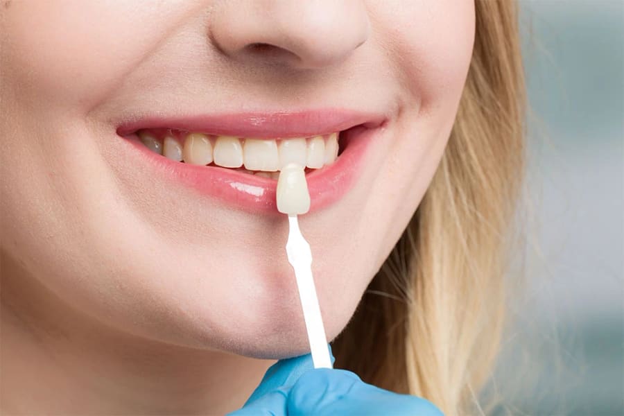 Facettes Dentaires — sourire naturel et harmonieux