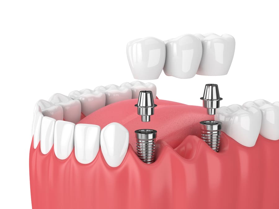 Implantologie Dentaire — remplacement de dent par implant