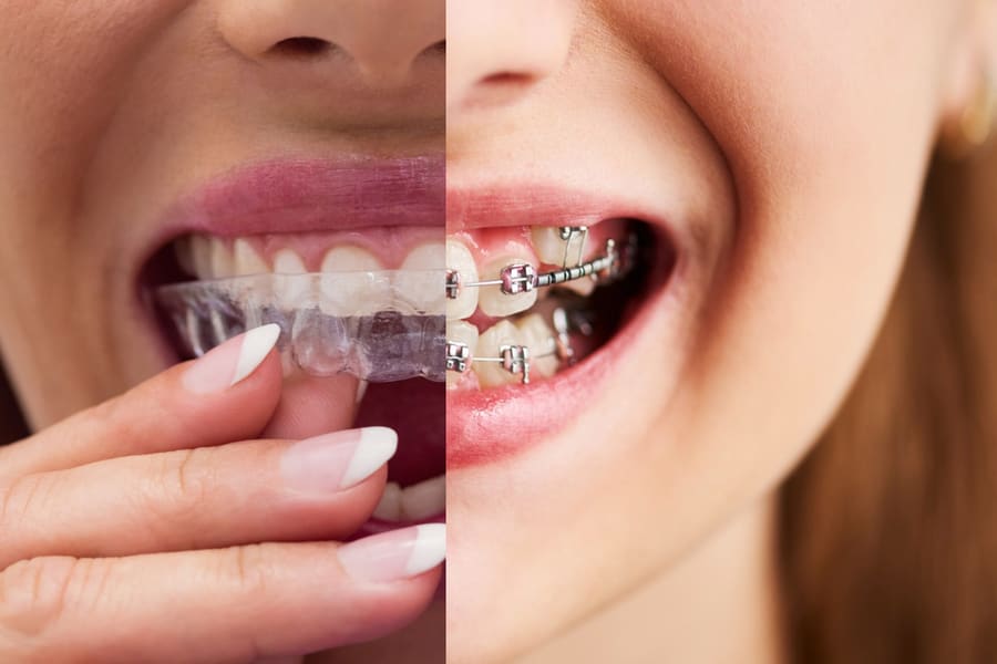 Orthodontie Avancée — bagues et gouttières transparentes